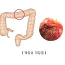 궤양성 대장염[ulcerative colitis] 이미지