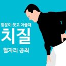 항문이 붓고 아플때...혈자리 이미지