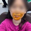 아라약국 | &lt;서산 아라치과&gt; 매복사랑니 발치 후기 *긴글주의*