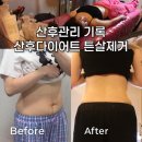 천안 신부동 산후관리 기록 2회차 아인체형전문샵 튼살제거 복부라인 관리 후기