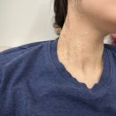 원레이져 | 겨울에 목 쥐젖 100개 넘게 10만 원 대에 레이저 제거한 내돈내산 후기 (통증, 시간, 관리 등)