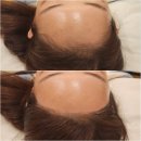 자인헤어# | 평택왁싱전문점 소사벌 니모네모에서의 헤어라인왁싱후기