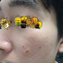 [내돈내산] 이대역 사월의봄 한의원 - 새살침 마지막 회차 후기2(유지침, 지움침)