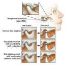 (주)덴스코어 | [안나필라테스] 턱에서나는 '딱'소리와 통증, 턱관절장애(Temporomandibular Joint Dysfunction : TMD)란?