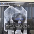 이튼튼구강악안면외과치과의원 | 치근단 수술 비용 실밥 제거 통증 붓기 멍 빠지는 시기