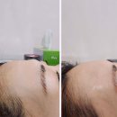 양재오라클피부과의원 티스토리