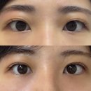 디에이치메디케어 | 내돈내산 겹주름 자연유착 쌍수 후기 : 일주일, 한달, 6주차 붓기 빠지는 경과