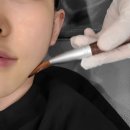 명동 피부과 올타이트 턱라인이 살아난 후기