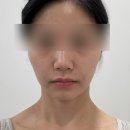 알파의료기 | [공지] 당산역피부과 덴서티알파팁+ 올타이트리프팅 후기 내돈내산 관리 추천