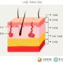 3도 화상[피부 전층손상] 이미지