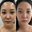포항시북구94 | 포항하이푸리프팅 찐찐찐강추! 이중턱 박살내고온 후기 (효과 대박 전후사진있음)
