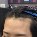 모모헤어라인 이미지