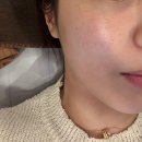 바른스킨 | 30대 탄력·모공 고민이라면? 홍대 피부과 자가혈 prp 쥬베룩 스킨부스터 후기