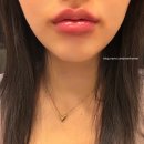 강남닥터에버스의원 | 광주 피부과 입술필러 맛집 내돈내산 후기 - 닥터에버스