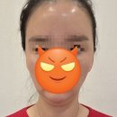 [내돈내산] 동성로 눈밑필러 1주일 후: 그냥 붓기였네? 👿(인모드+필러 돈지랄 후기)