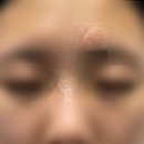 한강한의원 | [2601-02] 일기. 신사 피부 중점 한의원 (새살침, 패인흉터 제거, 오래된 흉터치료, 봉합흉터, 찍힘흉터)