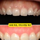인천 부평 거미스마일 잇몸성형 후기, 치관확장술로 짧은 치아를 자연스럽게