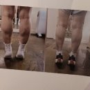 하이힐 | 청담동피부과 종아리보톡스로 종아리성형 성공한 내돈내산 후기(하이힐주사)