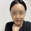 에그멍 | [관리] 쥬베룩 볼륨 후기 (통증, 붓기, 멍, 쥬베룩 몇cc, 코레지에그 관리, 선릉쥬베룩)