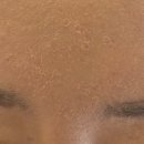 종각한의원 | [종각 피부과] 아토피원장의 스킨부스터 이야기(8-2) : 병원용 리들샷 후기