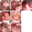 자궁내막 용종(폴립; Polyp), 자궁경부 용종 이미지