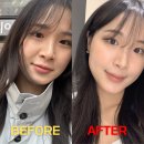 제31사단공병대대 | 신논현역 피부과 팔자 쥬베룩 솔직 후기! 팔자 고민 있으시면 꼭 보세요..♥