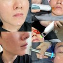 레이저 | 강남 LDM관리 제네시스레이저 네오빔레이저 후기, 효과 주기는?