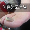 예쁜눈고운발 | 광주 발톱무좀 엄마 관리 후기