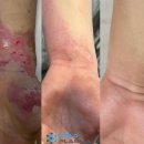 콜드플라즈마 이미지