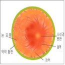 시신경염[optic neuritis] 이미지