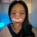 기능코 + 코성형 후기 ② | 수술 후 1주일 회복과정 (붓기·멍·솜제거 리얼후기)