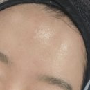 인천계양구효성동 탈라여드름관리, 메디스피큘 피부관리 잘하는곳 <투모로우 스킨엔바디>