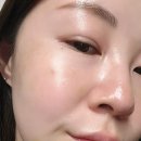 마산피부과 벨로테로 리바이브 통증 효과 후기 / 리쥬란 차이 비교