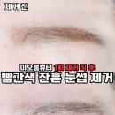 부림동-2 | 과천 부림동 눈썹문신제거 반영구문신제거 미오름뷰티