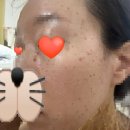 연세새살의원 | [리뷰] 연세보드미 편평사마귀 제거 후기 Day. 2~4