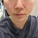 강남 논현 피부과 온다리프팅 받고 갸름해진 후기