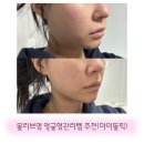 예원에스테틱 | 에르고바디 브이라인밴드 에이핑크 박초롱 얼굴형관리템 찐후기