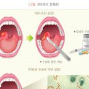 편도염 증세 원인 낫는법 편도 부었을때 급성 만성 열 편도선 붓는이유 편도선염 이미지