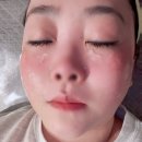 V-2 | 광주 첨단 피부과 셀렉V 레이저 잘하는 곳 2주차 후기