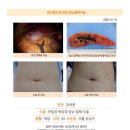 담석증수술후기. 3곳을 절제하는 다른 병원 대신 튼튼병원 김정윤 원장님께 단일공 복강경 수술을 받고자... 이미지