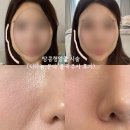 유앤박미래피부과의원 | 땅콩형얼굴시술 신사역피부과 손기술 맛집 후기(온다리프팅+윤곽주사,티타늄)