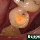 범플란트치과의원 네이버블로그