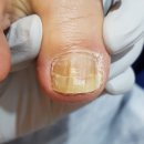 레푸스 평택점 | 레푸스 평택역점 발 케어가 남다름 평택 내성발톱 전문