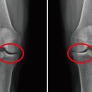 욱신욱신 아픈 내 무릎 관절염’ 어떻게 치료해야 할까? 이미지