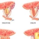 전립선암 1기 2기 3기 4기 및 생존율 이미지