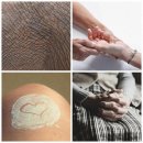 리엘르의원 | 피부 고민 해결 부위별 여드름 원인과 주방 관리, 보습제 선택 꿀팁