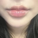 키스 | 광주 입술필러 잘하는 곳 레스틸렌키스 후기