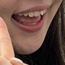 웃자치과교정과치과의원 | [성남 교정 치과 추천] 6개월 앞니 부분 교정 후기