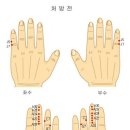 뜸 이미지