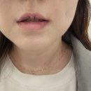 어린공주성형외과의원에서 국산 입술필러💋 맞은 내돈내산 후기 🥰 &amp; 한달 뒤 경과